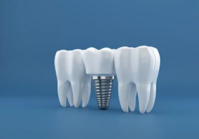cirurgia de implantes dentarios renderizacao em 3d 668290 126 result