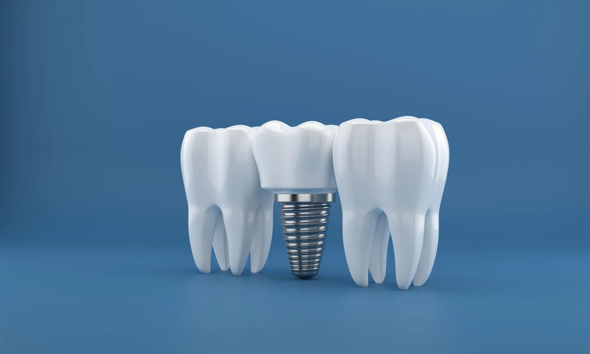 cirurgia de implantes dentarios renderizacao em 3d 668290 126 result