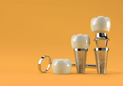 conceito de cirurgia de implantes dentarios renderizacao 3d 460848 3542 result