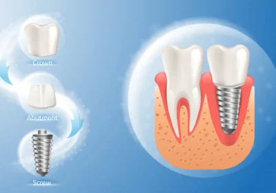 estrutura de imagem realista do implante dentario 81522 3559 result