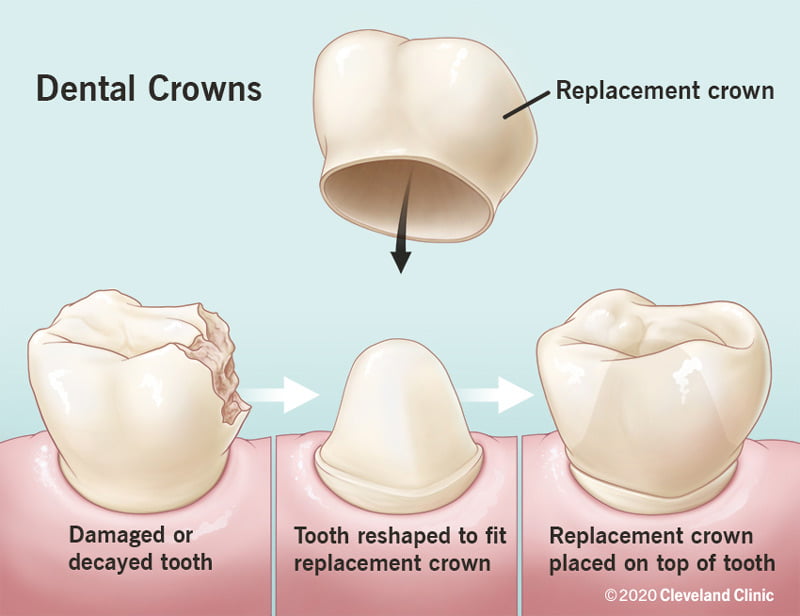 لبخندی دوباره: راهنمای جامع ترمیم دندانهای آسیبدیده یا از بین رفته 3 10923 dental crowns