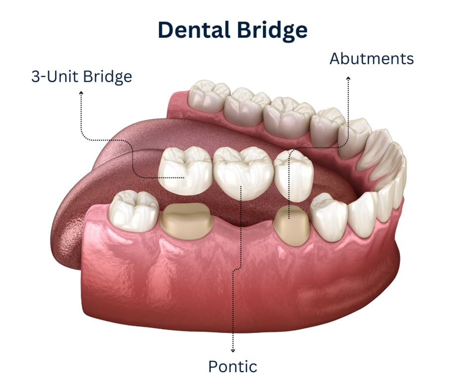 لبخندی دوباره: راهنمای جامع ترمیم دندانهای آسیبدیده یا از بین رفته 4 dental bridge