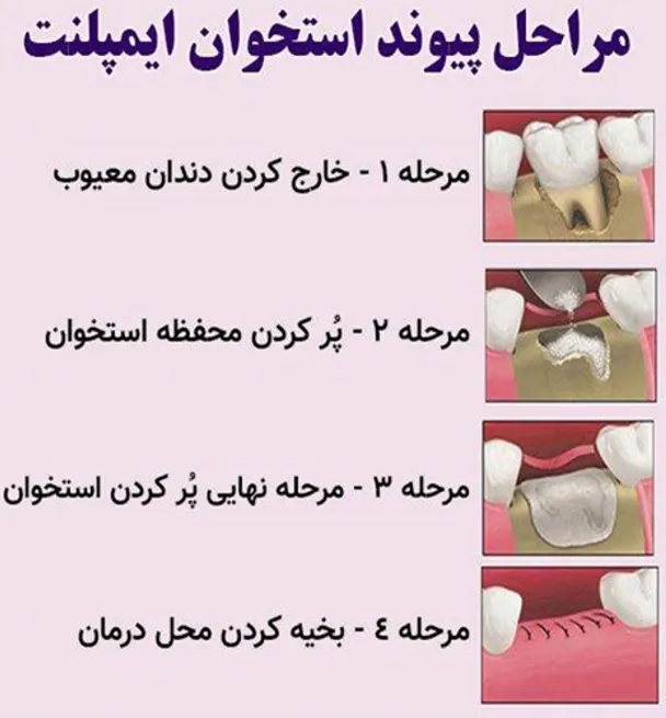 "گرافتهای استخوانی: راهکاری موثر برای ترمیم و بازسازی استخوان" 4 "مراحل پیوند استخوان ایمپلنت"