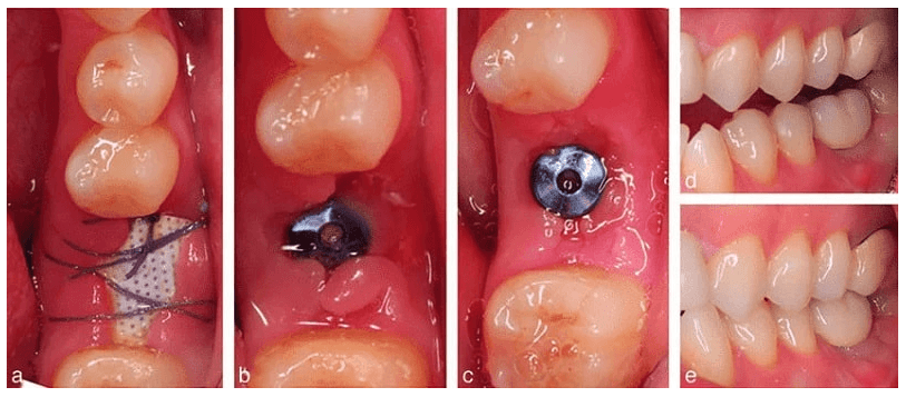 هیلینگ اباتمنت(Healing Abutment) 7 Captureب