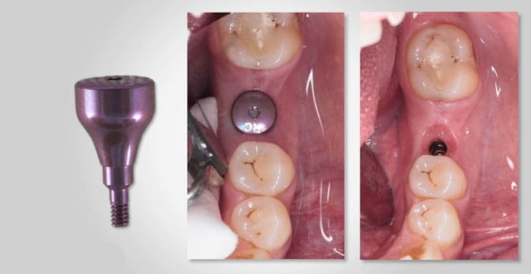 هیلینگ اباتمنت(Healing Abutment) 3 healing implant 1
