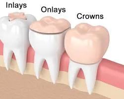 اینله (Inlay) و آنله (Onlay) سرامیکی: راهکاری زیبا و مقاوم برای ترمیم دندان 3 inlay1 urumdental