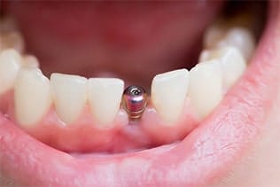 هیلینگ اباتمنت(Healing Abutment) 6 هیلینگ اباتمنت