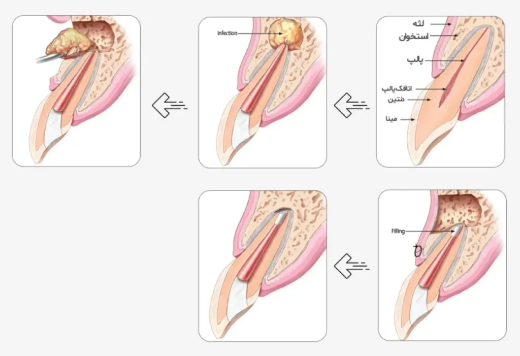 جراحی اپیکو دندان: راهی برای نجات دندانهای عفونی 3 Capture1233 urumdental