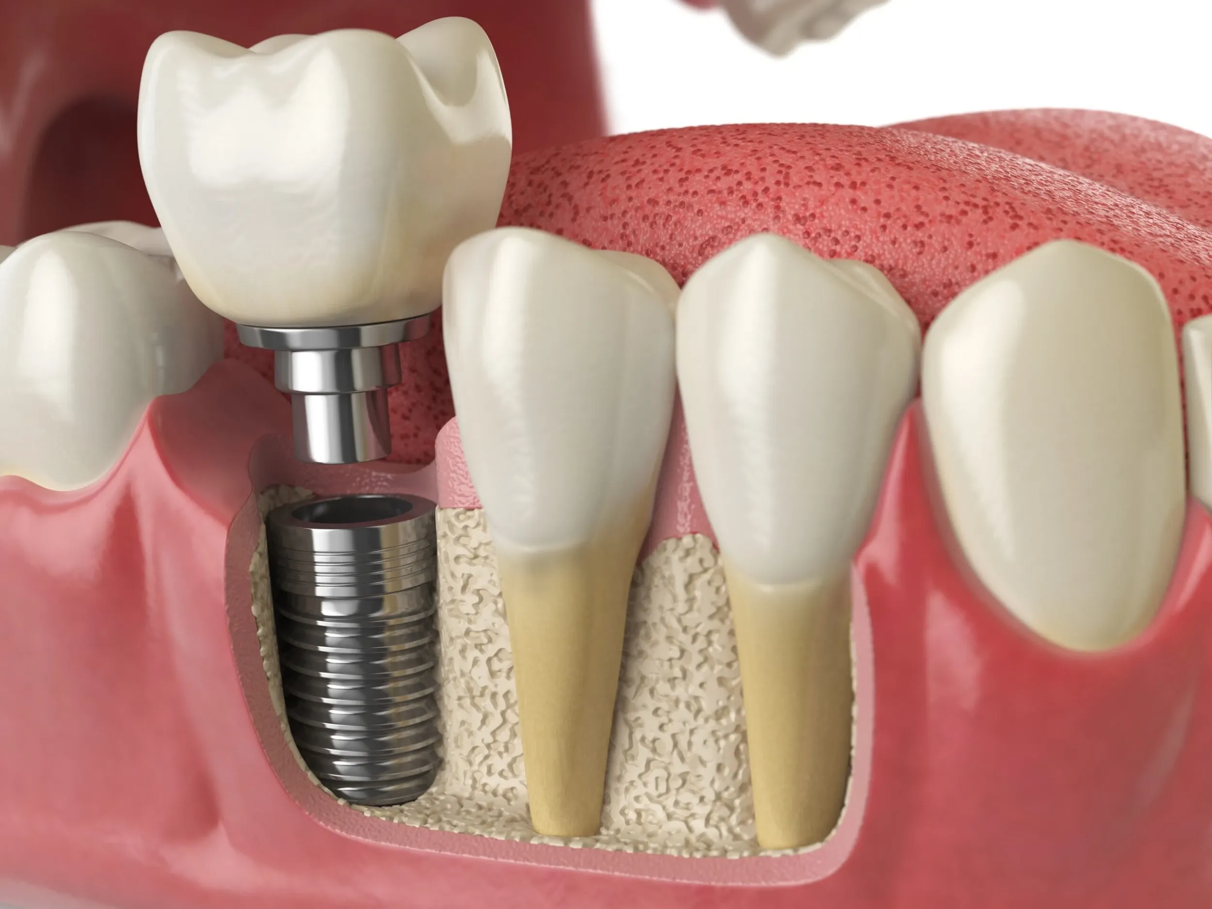 Falling healing implant urumdental