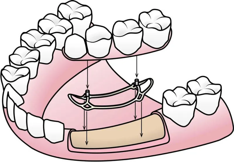 ایمپلنتهای سابپریوستئال: راه حلی نوین برای جایگزینی دندان 2 implant3 urumdental