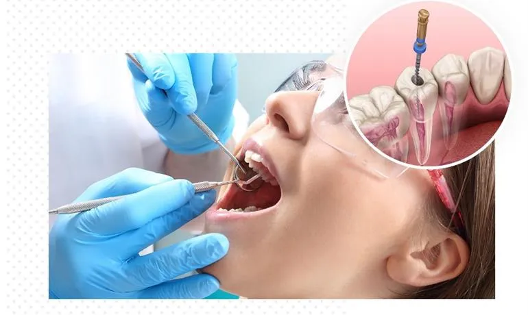 "اندودنتیکس: نجات دندانهای طبیعی با علم و تخصص" 4 287 urumdental