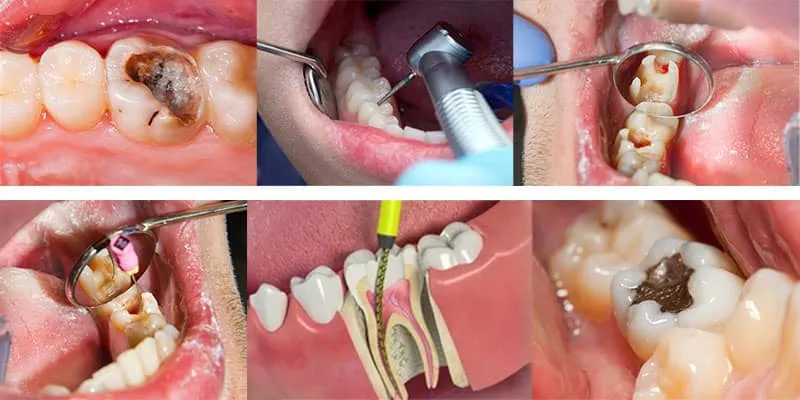 "اندودنتیکس: نجات دندانهای طبیعی با علم و تخصص" 2 Steps of root canal treatment urumdental