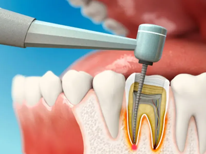 "اندودنتیکس: نجات دندانهای طبیعی با علم و تخصص" 3 درمان ریشه دندان urumdental