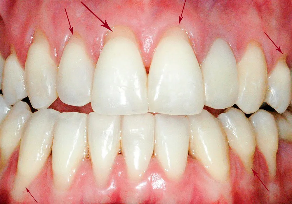 «تصویر تحلیل لثه و نمایان شدن ریشه دندان در بزرگسالان»