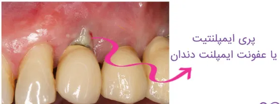 پریایمپلنتیت: بررسی جامع بیماری التهابی اطراف ایمپلنتهای دندانی 3 Frame 45026350 urumdental