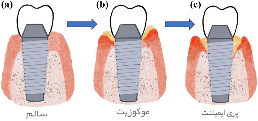 پریایمپلنتیت: بررسی جامع بیماری التهابی اطراف ایمپلنتهای دندانی 2 peri implant 1 urumdental